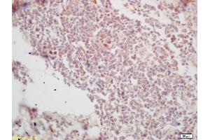 Formalin-fixed and paraffin embedded human lung carcinoma labeled with Rabbit Anti Histone H3-like protein Polyclonal Antibody, Unconjugated (ABIN670986) at 1:200 followed by conjugation to the secondary antibody and DAB staining (Centromeric Histone H3-Like Protein-2 (AA 51-145) antibody)