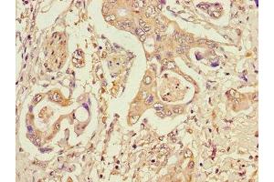 Immunohistochemistry of paraffin-embedded human pancreatic cancer using ABIN7150603 at dilution of 1:100 (STT3A antibody  (AA 39-114))