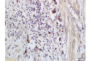 Formalin-fixed and paraffin embedded human colon carcinoma labeled with Anti-CCP Polyclonal Antibody, Unconjugated (ABIN736971) at 1:200 followed by conjugation to the secondary antibody and DAB staining (CRYGD antibody)