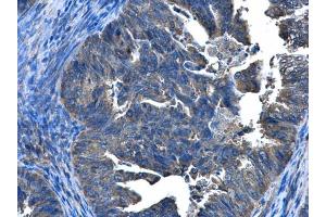 IHC-P Image CCDC83 antibody [N1C2] detects CCDC83 protein at cytoplasm and nucleus in human endometrial cancer by immunohistochemical analysis. (CCDC83 antibody)