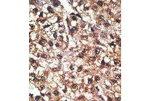 Formalin-fixed and paraffin-embedded human cancer tissue reacted with the primary antibody, which was peroxidase-conjugated to the secondary antibody, followed by AEC staining. (PINK1 antibody  (N-Term))