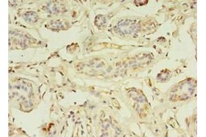 Immunohistochemistry of paraffin-embedded human breast cancer using ABIN7176199 at dilution of 1:100 (ZNF266 antibody  (AA 257-549))