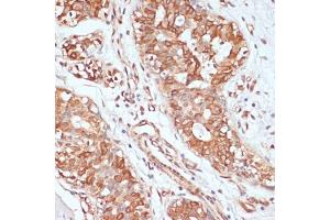 Immunohistochemistry of paraffin-embedded human mammary cancer using PTPRN2 antibody (ABIN7269710) at dilution of 1:100 (40x lens).
