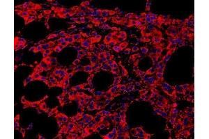 IF analysis of MYD88 using anti-MYD88 antibody (ABIN3043887) MYD88 was detected in paraffin-embedded section of human mammary cancar tissues.