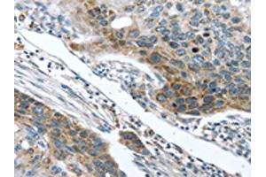 The image on the left is immunohistochemistry of paraffin-embedded Human esophagus cancer tissue using ABIN7131406(TMPRSS5 Antibody) at dilution 1/25, on the right is treated with fusion protein. (TMPRSS5 antibody)