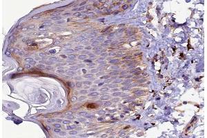 ABIN6267491 at 1/100 staining human Skin cancer tissue sections by IHC-P.