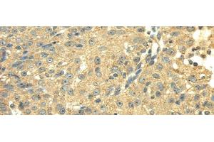 Immunohistochemistry of paraffin-embedded Human breast cancer using SDHA Polyclonal Antibody at dilution of 1/40 (SDHA antibody)