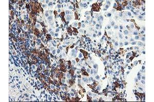 Immunohistochemical staining of paraffin-embedded Carcinoma of Human lung tissue using anti-GBP1 mouse monoclonal antibody. (GBP1 antibody)