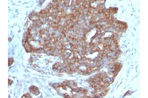 Formalin-fixed, paraffin-embedded human Ovarian Carcinoma stained with pS2 Monoclonal Antibody (SPM313). (TFF1 antibody  (AA 57-84))