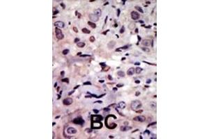 Formalin-fixed and paraffin-embedded human cancer tissue reacted with the primary antibody, which was peroxidase-conjugated to the secondary antibody, followed by AEC staining. (ALK antibody  (N-Term))