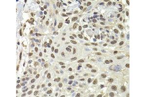 Immunohistochemistry of paraffin-embedded Human well-differentiated squamous skin carcinoma using PUF60 Polyclonal Antibody at dilution of 1:100 (40x lens). (PUF60 antibody)