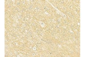 ABIN6262899 and ABIN6273003 at 1/100 staining human glioblastoma by IHC-P. (L2HGDH antibody  (Internal Region))