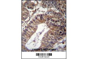 GCC1 Antibody immunohistochemistry analysis in formalin fixed and paraffin embedded human colon carcinoma followed by peroxidase conjugation of the secondary antibody and DAB staining. (GCC1 antibody  (C-Term))