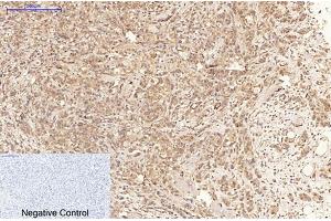 Immunohistochemical analysis of paraffin-embedded human breast cancer tissue. (MLKL antibody  (pSer358))