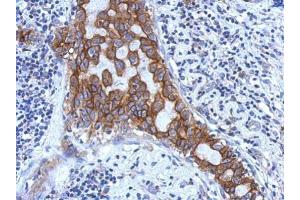 IHC-P Image Immunohistochemical analysis of paraffin-embedded human breast cancer, using IL1RAP, antibody at 1:500 dilution. (IL1RAP antibody)