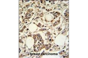 PIGM Antibody (C-term) (ABIN650949 and ABIN2840006) IHC analysis in formalin fixed and paraffin embedded breast carcinoma followed by peroxidase conjugation of the secondary antibody and DAB staining.