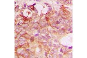 Immunohistochemical analysis of PIG3 staining in human breast cancer formalin fixed paraffin embedded tissue section. (MRPL41 antibody  (C-Term))