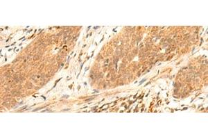 Immunohistochemistry of paraffin-embedded Human esophagus cancer tissue using HES7 Polyclonal Antibody at dilution of 1:25(x200) (HES7 antibody)
