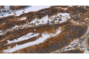 Immunohistochemistry of paraffin-embedded Human colon cancer tissue using ARHGEF12 Polyclonal Antibody at dilution 1:30 (ARHGEF12 antibody)