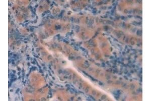 Detection of CTSL in Human Thyroid cancer Tissue using Polyclonal Antibody to Cathepsin L (CTSL) (Cathepsin L antibody  (AA 114-288))