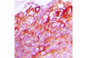 Immunohistochemical analysis of GPR170 staining in human breast cancer formalin fixed paraffin embedded tissue section. (OXER1 antibody)