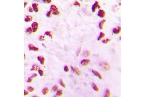 Immunohistochemical analysis of CLK2 staining in human lung cancer formalin fixed paraffin embedded tissue section. (CLK2 antibody  (N-Term))