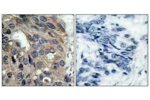 Immunohistochemical analysis of paraffin-embedded human breast carcinoma tissue using Src(Phospho-Tyr529) Antibody(left) or the same antibody preincubated with blocking peptide(right).
