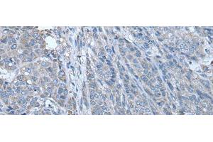 Immunohistochemistry of paraffin-embedded Human liver cancer tissue using ZC3HAV1 Polyclonal Antibody at dilution of 1:70(x200) (ZC3HAV1 antibody)