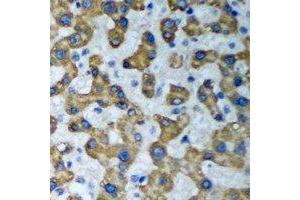 Immunohistochemical analysis of HADHA staining in human liver cancer formalin fixed paraffin embedded tissue section. (HADHA antibody)