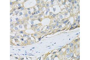 Immunohistochemistry of paraffin-embedded Human breast cancer using CD98 Polyclonal Antibody at dilution of 1:100 (40x lens). (SLC3A2 antibody)