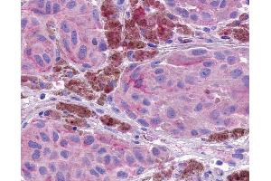 Anti-NPBWR1 / GPR7 antibody IHC of human Skin, Melanoma. (NPBWR1 antibody  (Extracellular Domain))