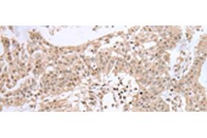 Immunohistochemistry of paraffin-embedded Human colorectal cancer tissue using UBE2I Polyclonal Antibody at dilution of 1:40(x200) (UBE2I antibody)