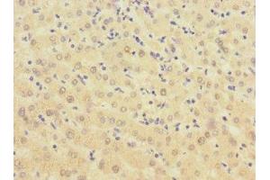 Immunohistochemistry of paraffin-embedded human liver cancer using ABIN7145876 at dilution of 1:100 (BTN1A1 antibody  (AA 27-210))