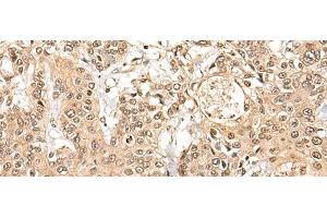 Immunohistochemistry of paraffin-embedded Human prost ate cancer tissue using NCAPH Polyclonal Antibody at dilution of 1:45(x200) (NCAPH antibody)