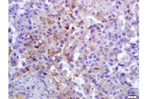 Formalin-fixed and paraffin embedded human lung carcinoma labeled with Anti-PLK1 Polyclonal Antibody, Unconjugated (ABIN700435) at 1:200 followed by conjugation to the secondary antibody and DAB staining (PLK1 antibody  (AA 201-300))