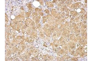 IHC-P Image Aldolase B antibody detects ALDOB protein at cytosol on human hepatoma by immunohistochemical analysis. (ALDOB antibody)