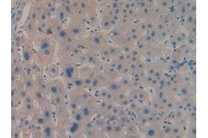 DAB staining on IHC-P; Samples: Human Liver cancer Tissue