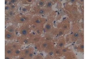 Detection of MAPT in Human Liver cancer Tissue using Polyclonal Antibody to Tau Protein (MAPT)
