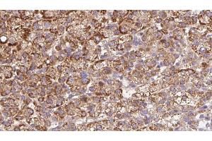 ABIN6272675 at 1/100 staining Human liver cancer tissue by IHC-P.