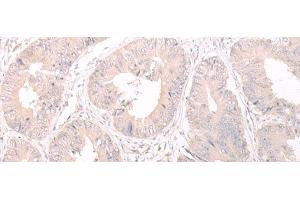 Immunohistochemistry of paraffin-embedded Human colorectal cancer tissue using FOXRED2 Polyclonal Antibody at dilution of 1:35(x200)
