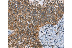 Immunohistochemistry of Human thyroid cancer using ANKHD1 Polyclonal Antibody at dilution of 1:40 (ANKHD1 antibody)