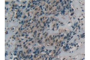 Detection of DbH in Human Breast cancer Tissue using Polyclonal Antibody to Dopamine Beta Hydroxylase (DbH) (DBH antibody  (AA 335-571))