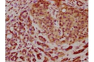 IHC image of ABIN7145792 diluted at 1:200 and staining in paraffin-embedded human pancreatic cancer performed on a Leica BondTM system. (BROX antibody  (AA 288-409))