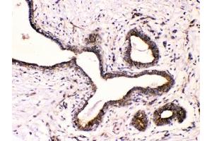 IHC testing of FFPE human breast cancer with Beta III Tubulin antibody at 1ug/ml. (TUBB3 antibody  (AA 383-412))