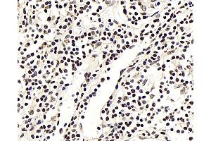 Immunohistochemistry analysis of paraffin-embedded human lung cancer using NFKBIB Polyclonal Antibody at dilution of 1:300. (NFKBIB antibody)