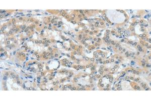 Immunohistochemistry of paraffin-embedded Human thyroid cancer tissue using ASH2L Polyclonal Antibody at dilution 1:60 (ASH2L antibody)