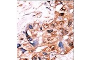 Formalin-fixed and paraffin-embedded human cancer tissue reacted with the primary antibody, which was peroxidase-conjugated to the secondary antibody, followed by AEC staining. (YES1/SRC (pTyr530) antibody)