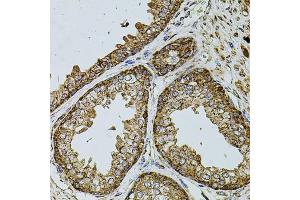Immunohistochemistry of paraffin-embedded human prostate using UQCRC1 antibody (ABIN5971722) at dilution of 1/100 (40x lens). (UQCRC1 antibody)