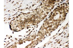 Anti- Lamin A Picoband antibody, IHC(P) IHC(P): Human Mammary Cancer Tissue (Lamin A/C antibody  (AA 481-646))
