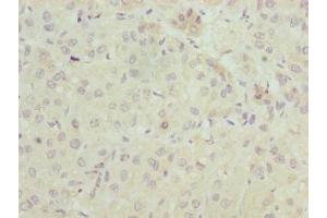 Immunohistochemistry of paraffin-embedded human liver cancer using ABIN7151560 at dilution of 1:100 (ELOVL2 antibody  (AA 91-174))